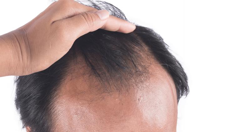 chute-de-cheveux-effluvium-alopecie-difference