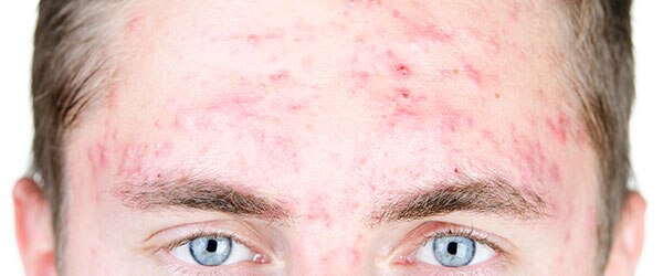 Acne-forehead