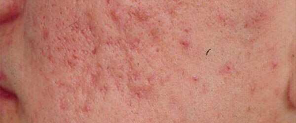 Acne-scars