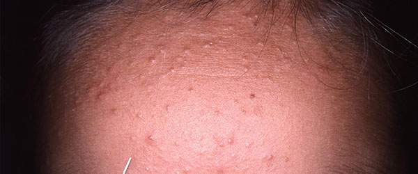 acne-retentional