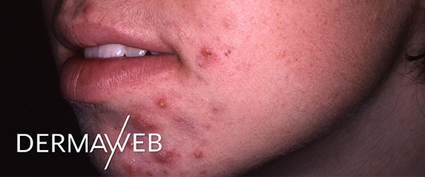 Inflammatory-acne