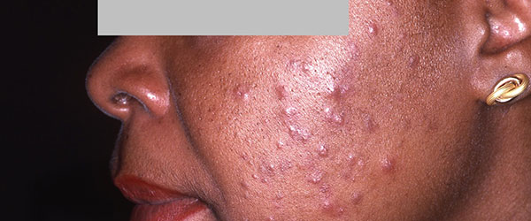 Nodular-acne