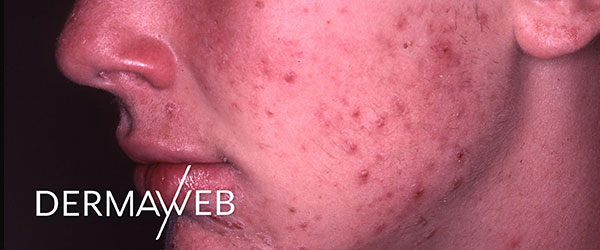 Severe-acne