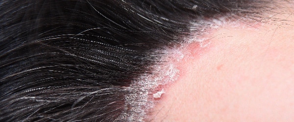 Plaque psoriasis scalp