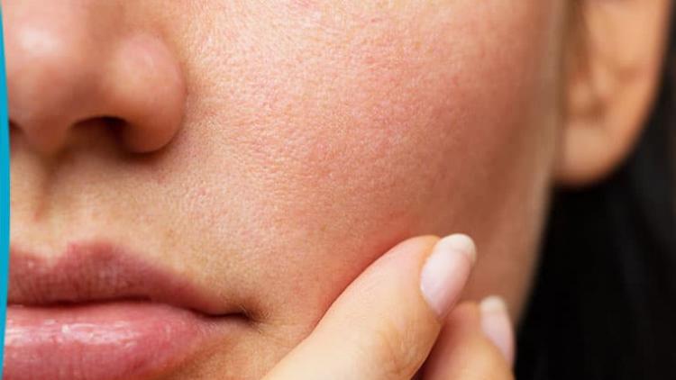 dilated pores of oily skin