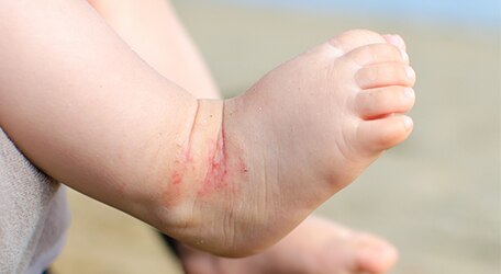 photo-eczema-bebe
