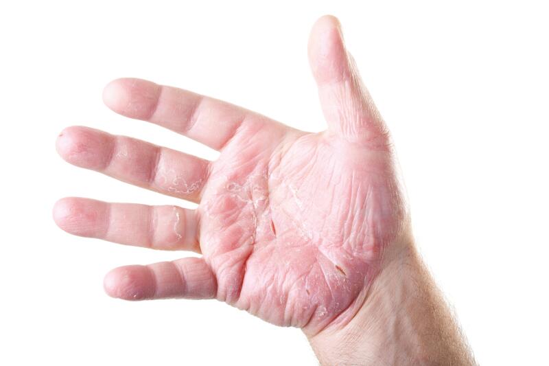 eczema-main-doigts