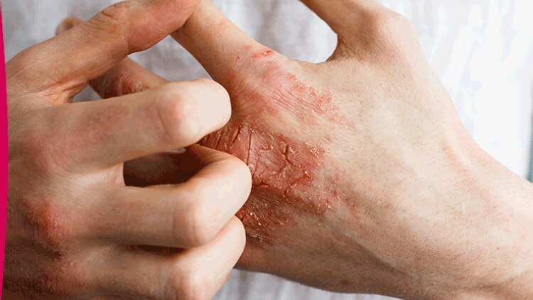 eczema-chez-l-adulte